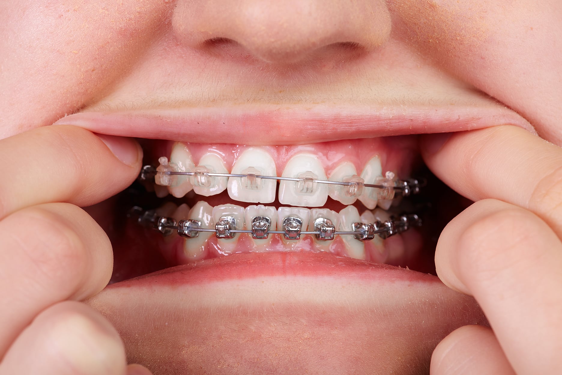 Dentofacial Orthopedics Dr. Bill Willard Zurcher Orthodontist in Draper, UT 84020 West Jordan, UT 84084