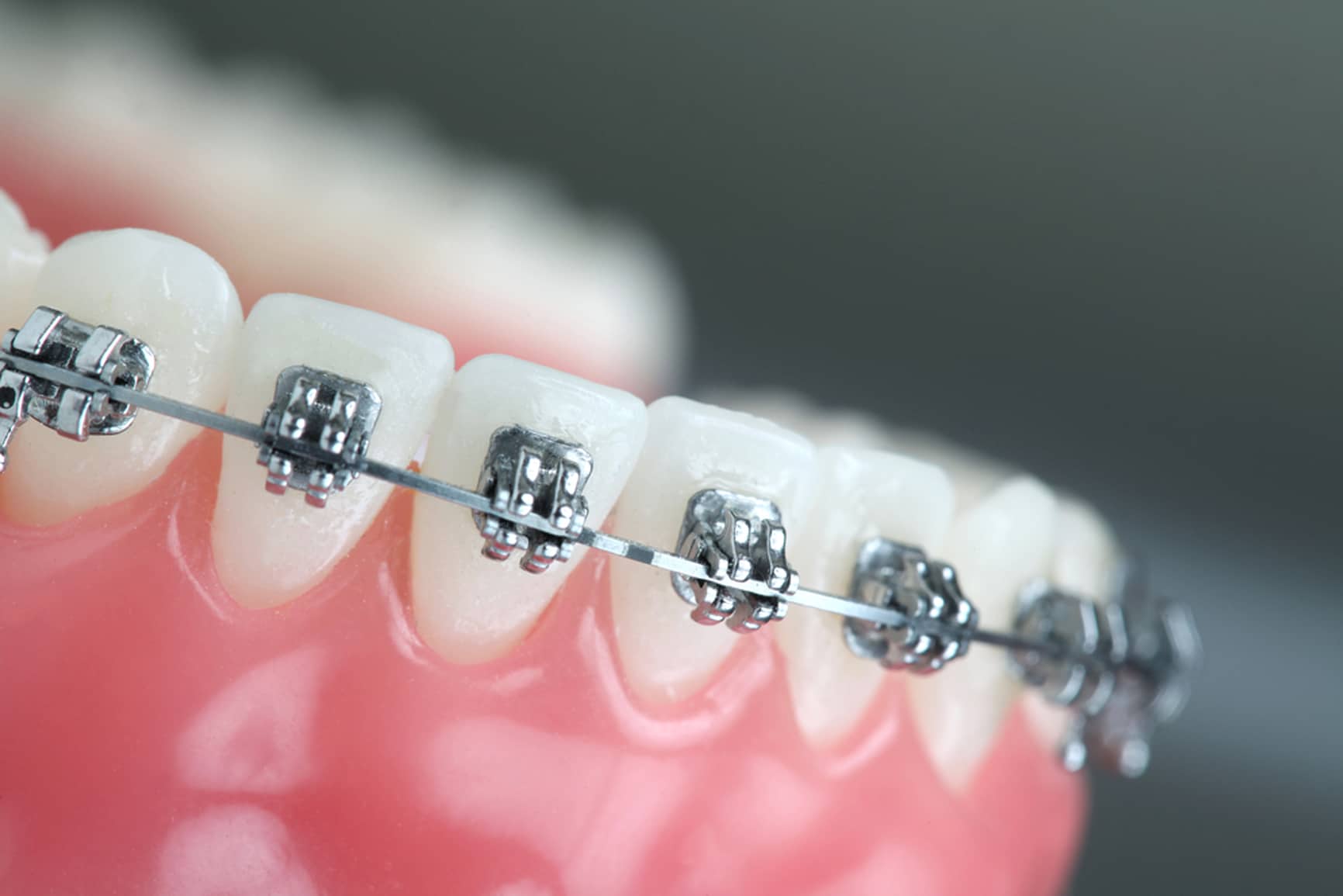 What to Expect and How to Care for Your New Braces in South Jordan Orthodontics Dr. Bill Willard Zurcher Orthodontist in Draper, UT 84020 West Jordan, UT 84084
